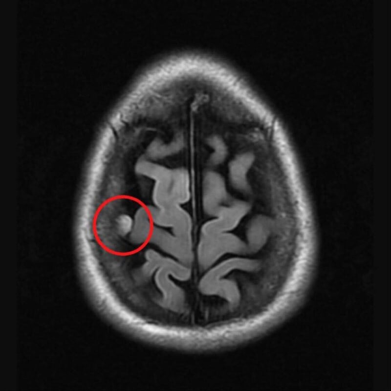 An MRI Image showing a small meningioma.